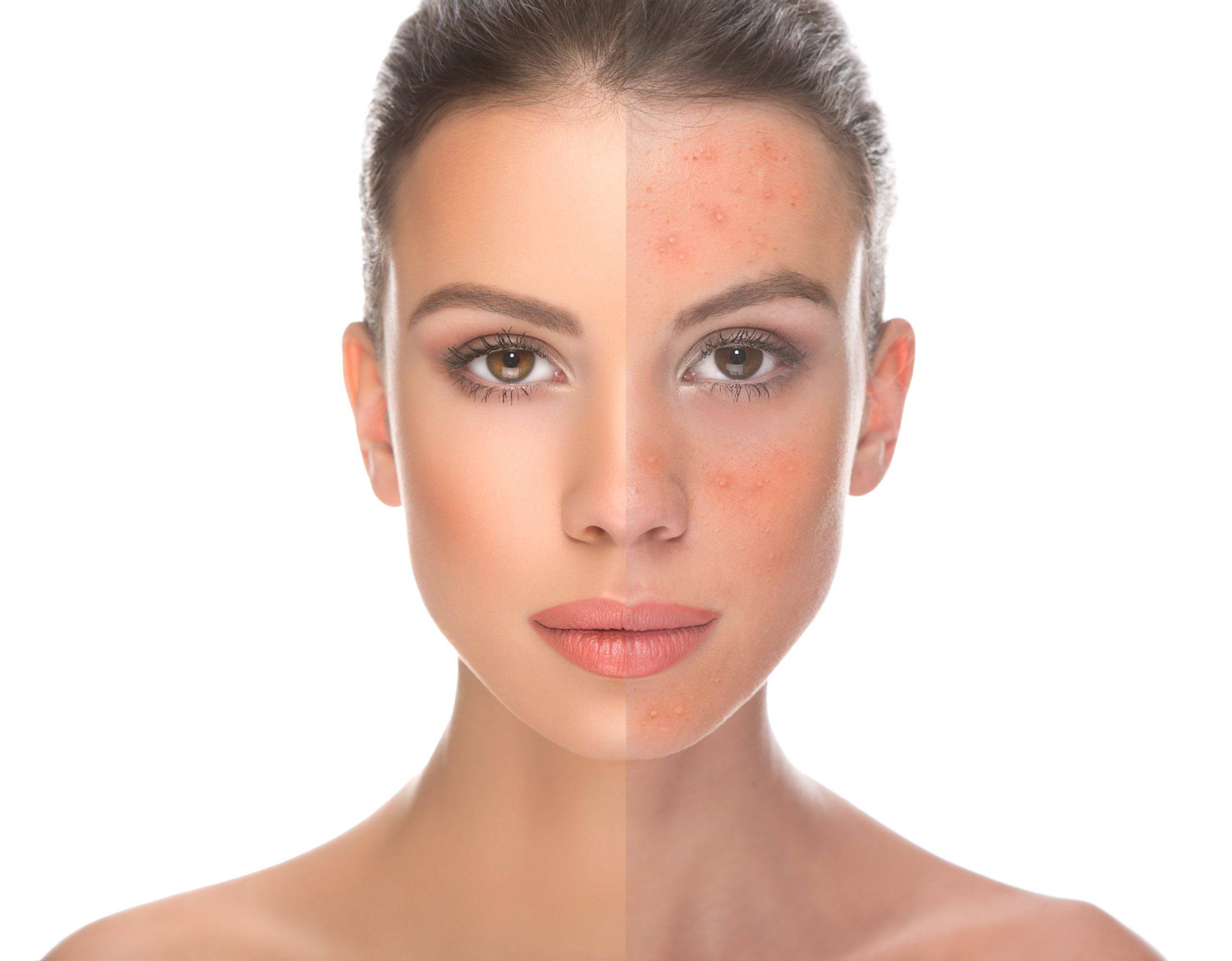 Exosomen für Hautaufbau – Ästhetische Medizin München 25 Vorher Nachher mit Exosomen, Exosomenbehandlung, Exosomen Therapie, Biorevitalisierung