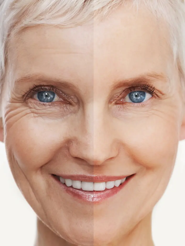 Exosomen für Hautaufbau – Ästhetische Medizin München 24 Porträt einer älteren Frau mit einem Vergleich von Gesichtshälften vor und nach einer Anti-Aging-Behandlung, die Faltenreduktion zeigt.