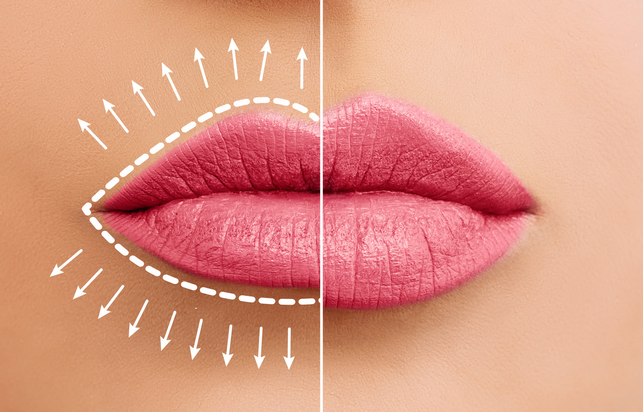 Lippenvergrößerung: Schönere Lippen mit Hyaluronsäure-Fillern 50 iStock 1320127153