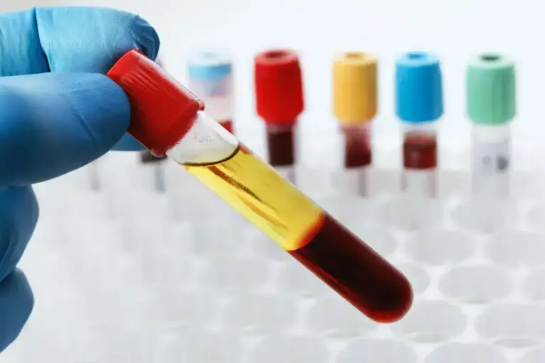 Vitamin B12 Mangel: Symptome, Ursachen & Behandlung 25 Blutprobe in einem Reagenzglas mit Handschuh gehalten.