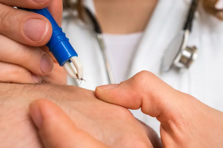Zeckenentfernung mit Pinzette zur Vorbeugung von FSME und Borreliose – Hausarzt Neuhausen bietet FSME-Impfung in München an.