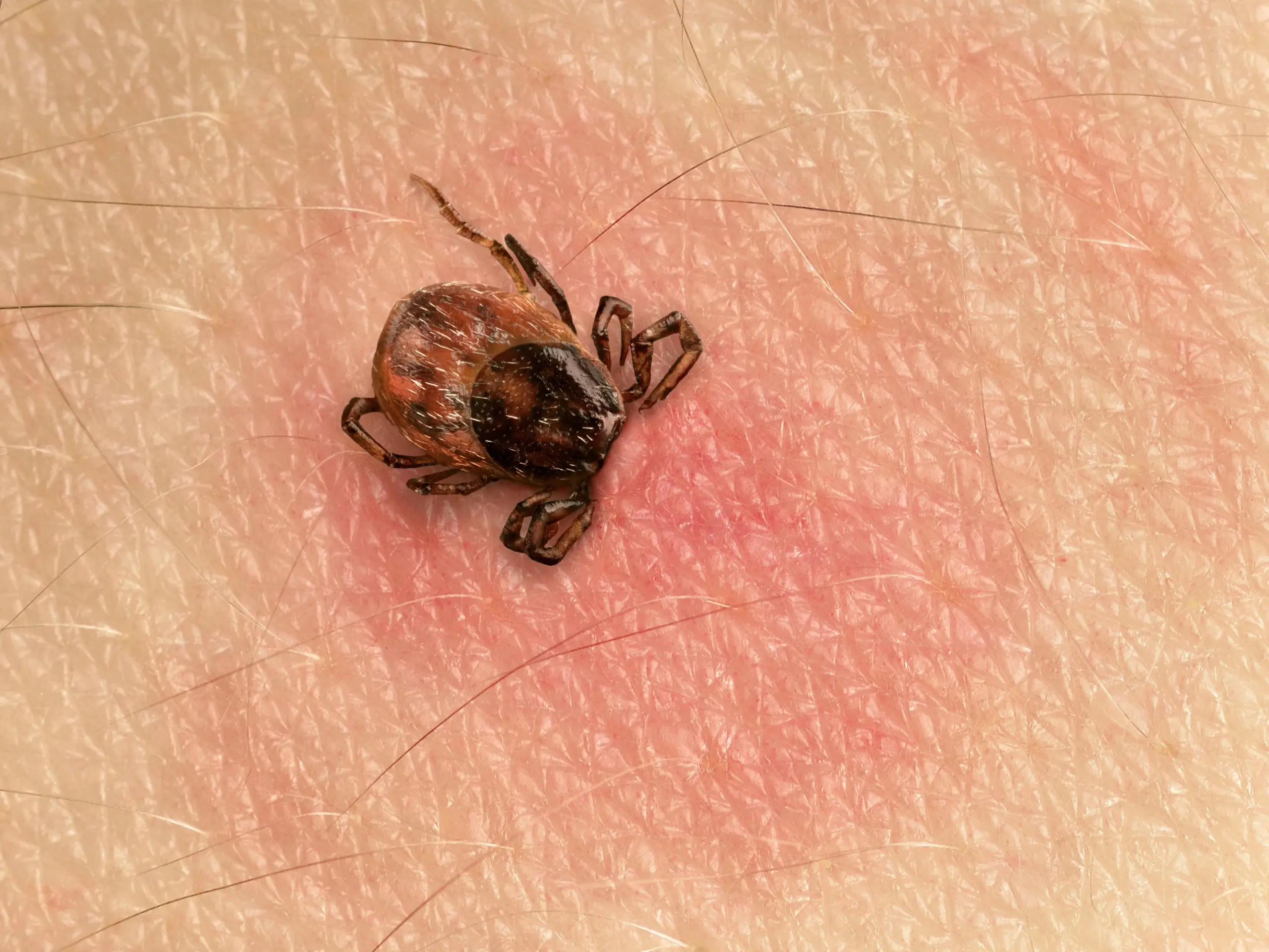 Zecken: FSME, Borreliose, Symptome und Entfernung – FSME-Impfung in München 8 Entfernen mit Pinzette – Anleitung