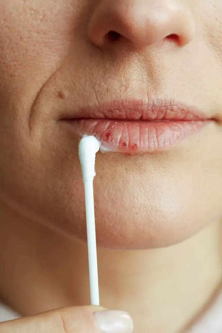 Lippen Herpes im Winter: Ursachen, Symptome & Behandlung 25 Dummy Alt-Text für iStock-1488599974.jpg