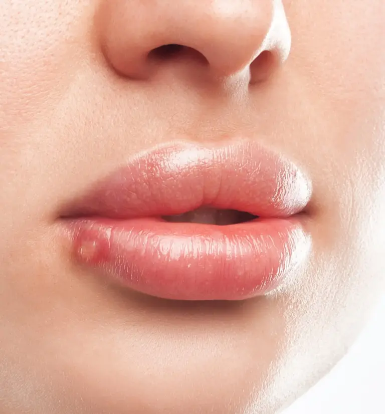 Lippen Herpes im Winter: Ursachen, Symptome & Behandlung 24 Dummy Alt-Text für iStock-2145815831.jpg