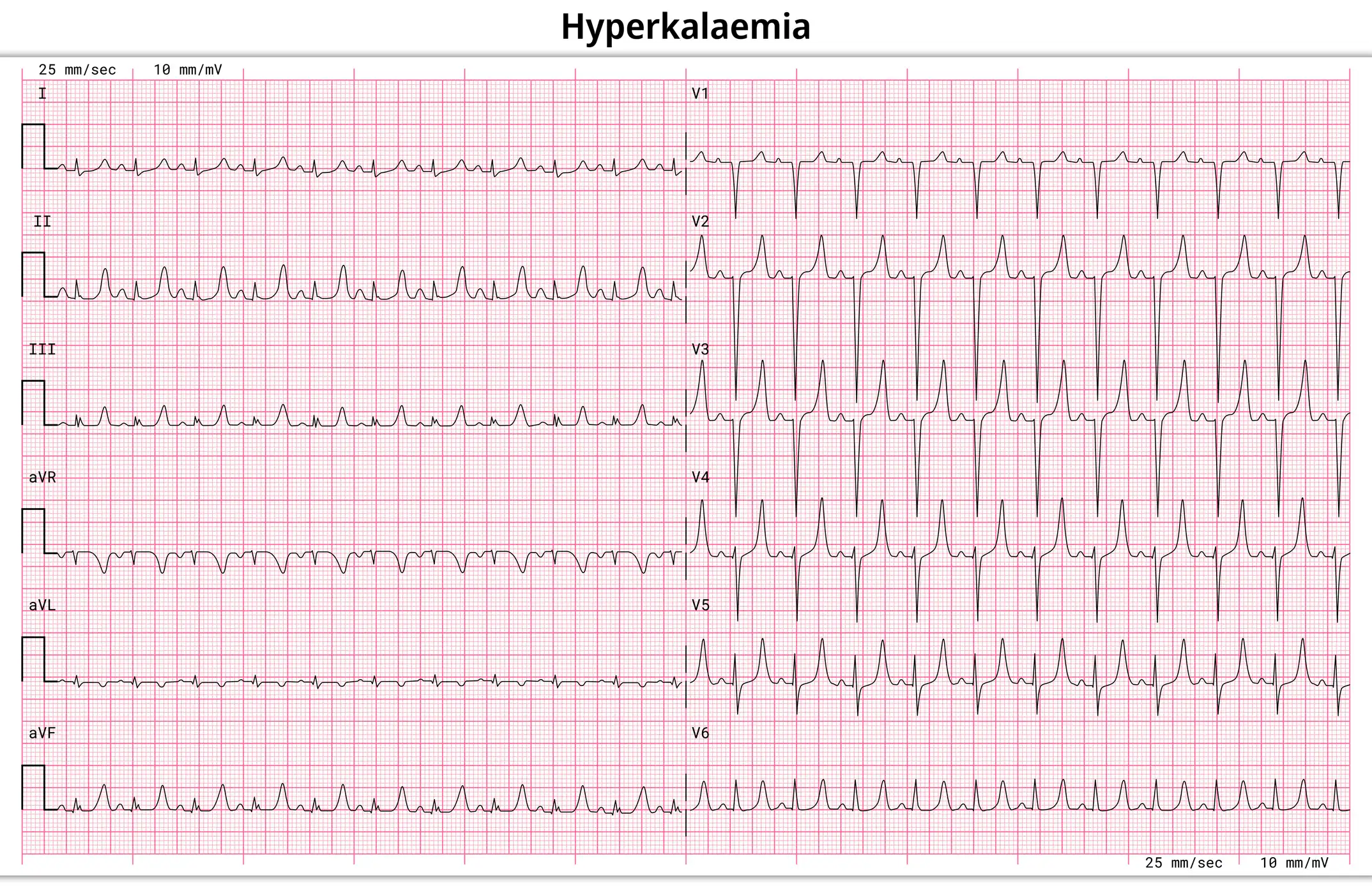 Hyperkaliämie (Kalium zu hoch): Symptome, Ursachen, EKG & Behandlung 6 EKG-Veränderungen bei erhöhten Kaliumspiegeln: spitze T-Wellen, QRS-Verbreiterung