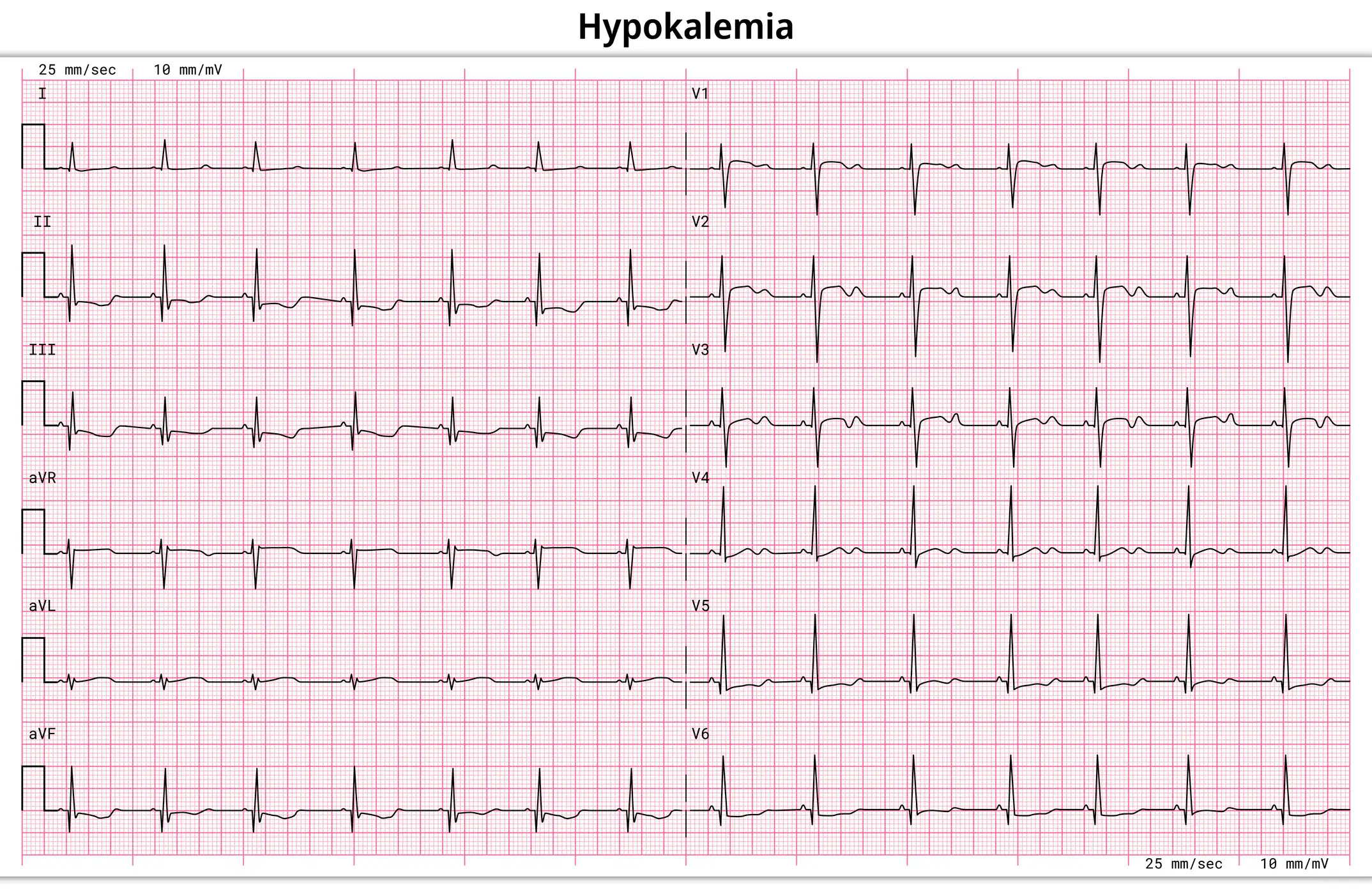 Hypokaliämie EKG: flache/negative T, U-Wellen, ST-Senkung