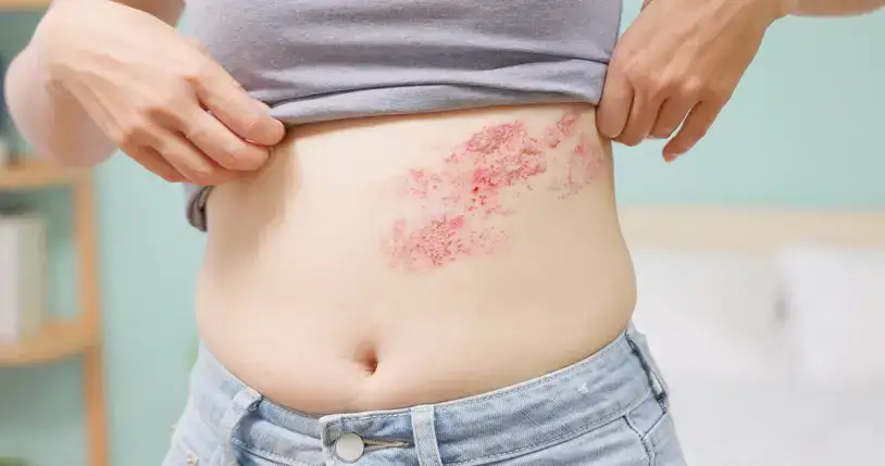 Herpes Zoster Impfung