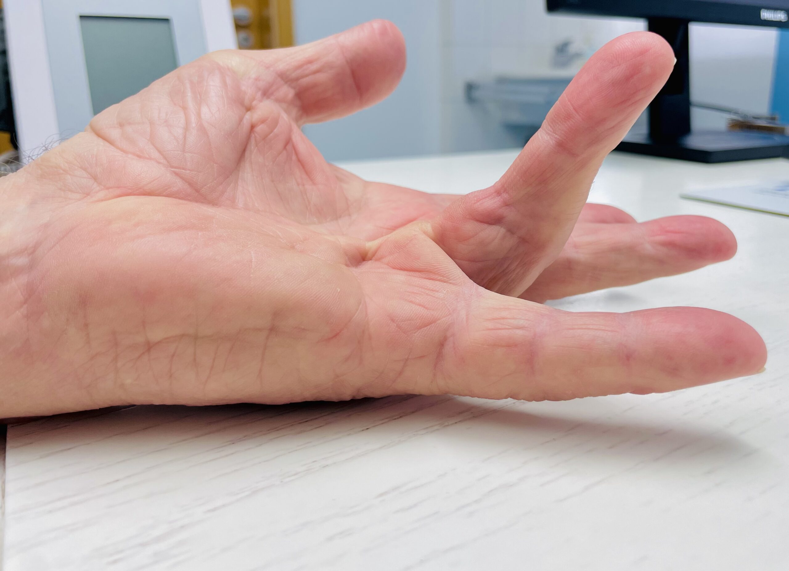 Dupuytren 2 Bindegewebe der Handfläche – Palmaraponeurose (Illustration)