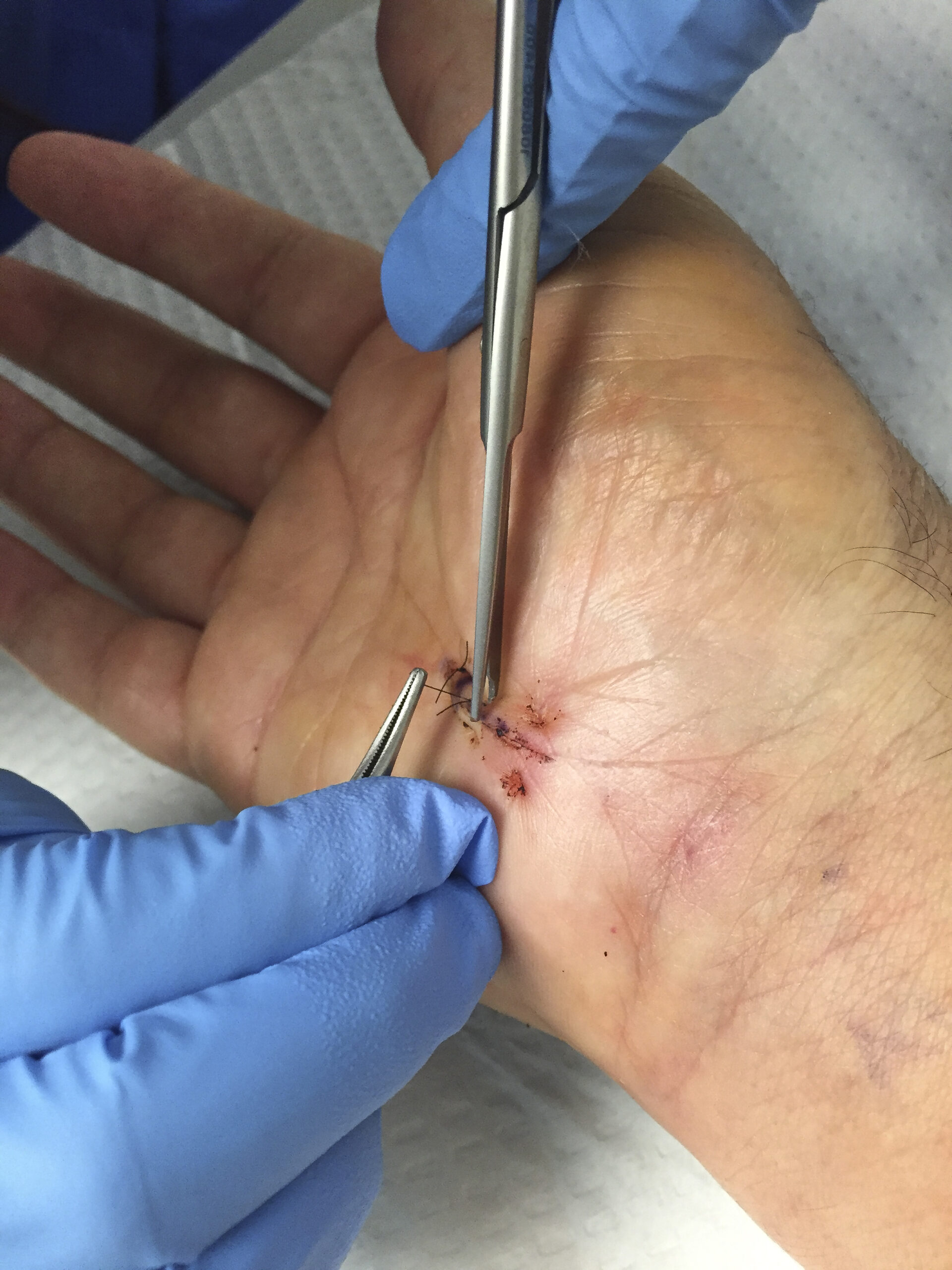 Dupuytren 3 Dupuytren OP & Behandlungsoptionen – Handchirurgie