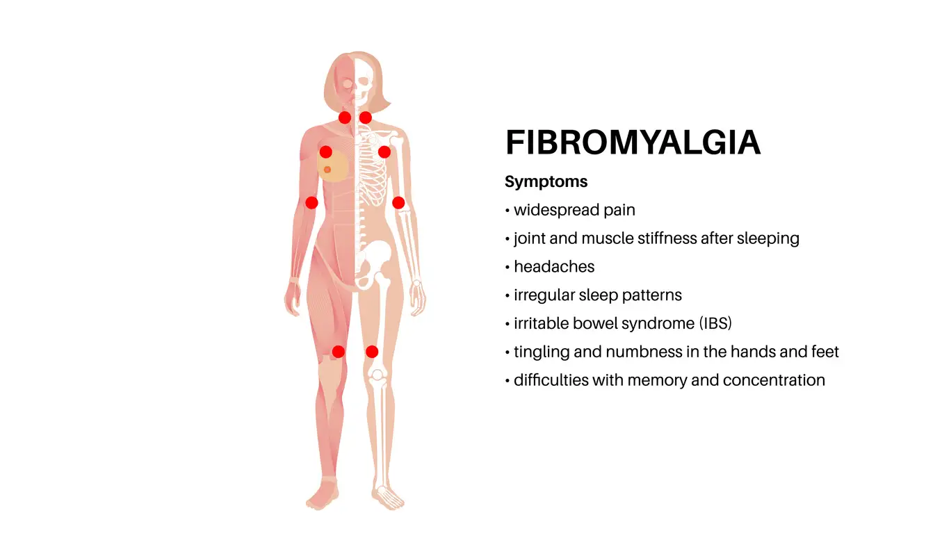 Fibromyalgie-Symptome Schaubild – Körperregionen und typische Schmerzverteilung