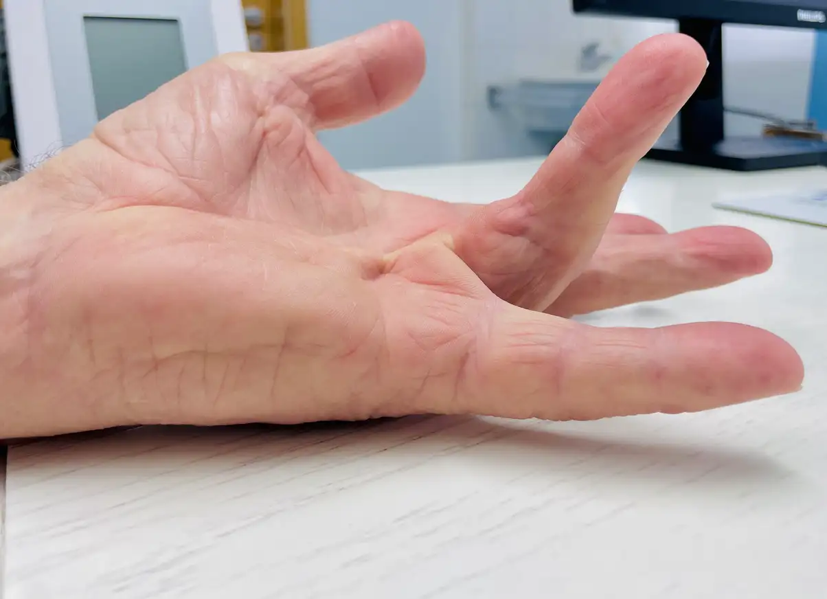 Morbus Dupuytren München: Knoten und Stränge in der Handfläche – Hausarztpraxis am Romanplatz